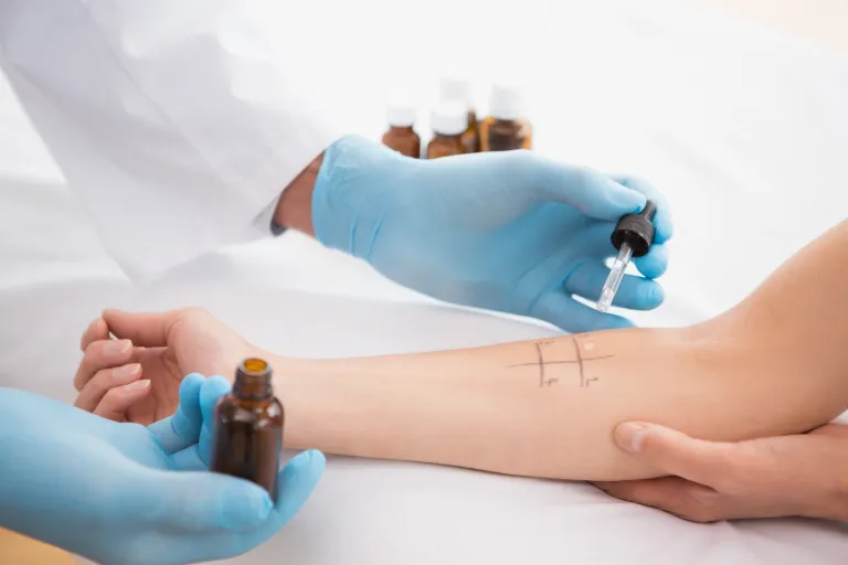 Healthcare professional performing a skin prick test